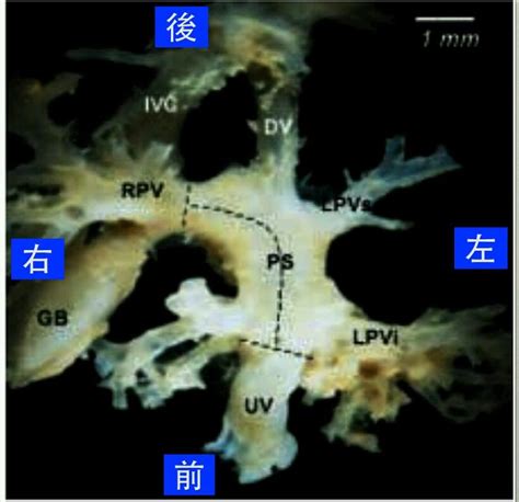 臍靜脈 充氧血|孕兒診所賴錫鉅醫師 88 產前診斷持續性右側臍靜脈